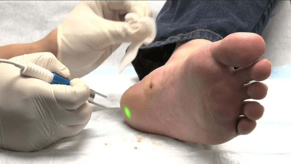 Tratamento da verruga plantar