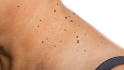 Como se livrar do Papilloma ao redor do pescoço
