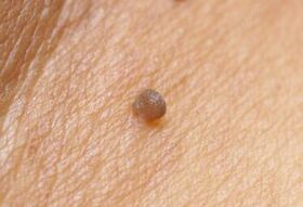 Imagem clínica de Papilloma