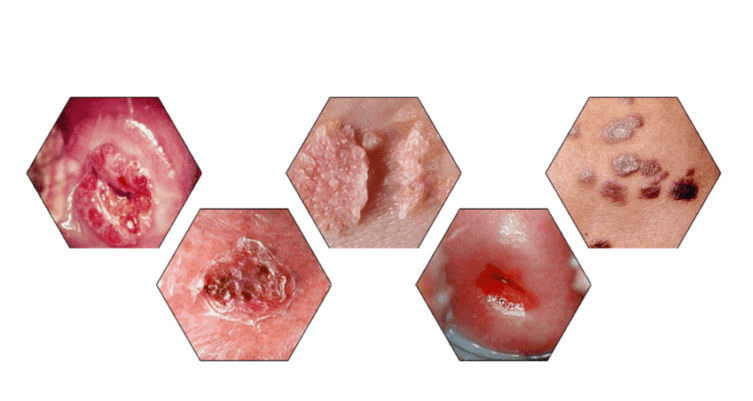 Por que os papilomas são perigosos