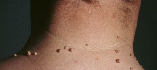 como se livrar dos papilomas