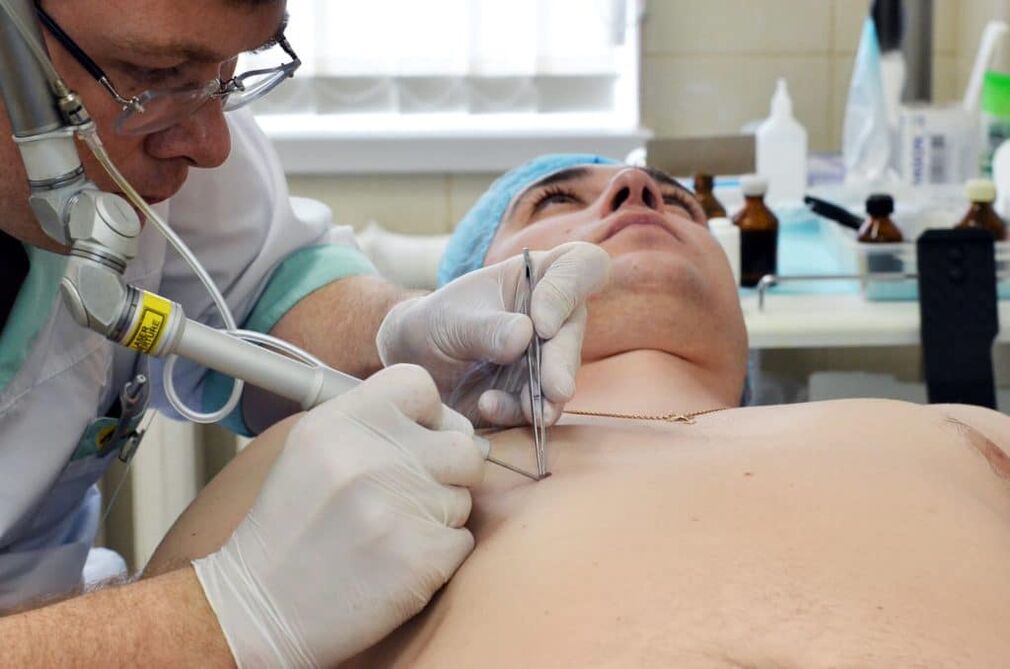 como se livrar de verrugas no corpo