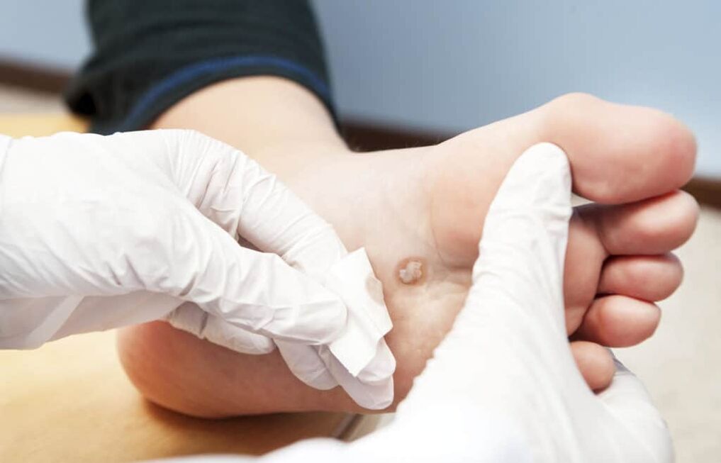 por que aparecem verrugas no corpo