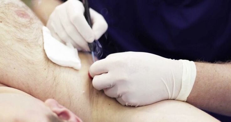 métodos profissionais para remoção de papilomas no corpo humano