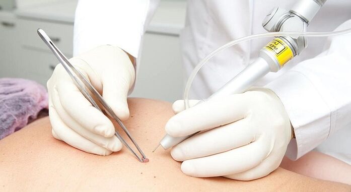 remoção a laser de papiloma para papilomavírus