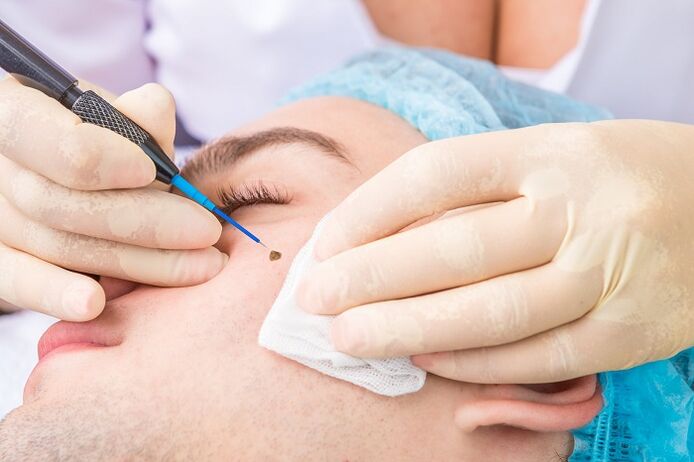 remoção de papiloma na face devido ao papilomavírus humano