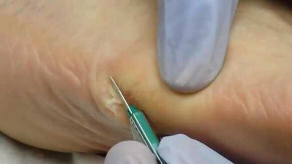 Remoção cirúrgica de uma verruga plantar